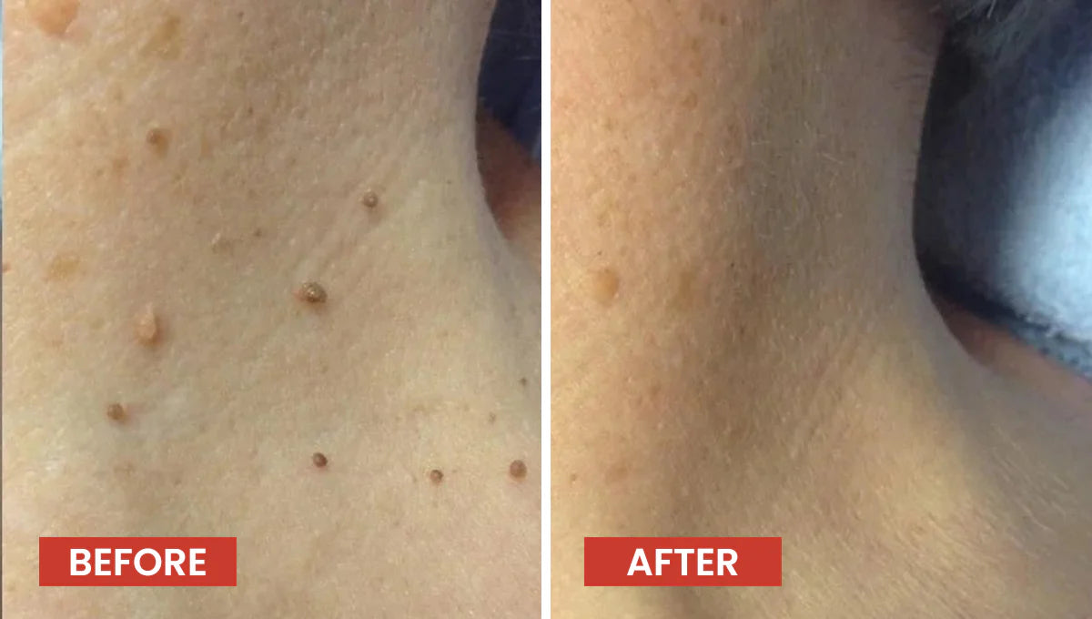 Kashio DermaSmooth Skin Tag Remover Patches – Fast-Acting, Painless & Natural Formula for Clear, Smooth Skin